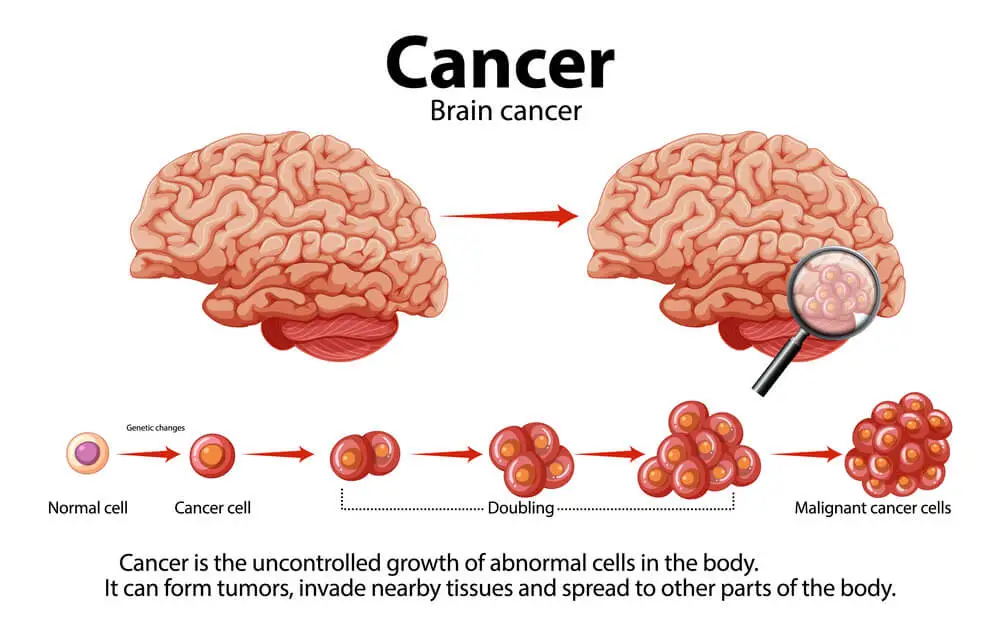 Brain Tumor Treatment in India